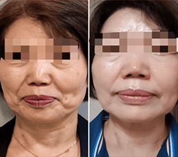 SYNERFILL PLLA FACE (ácido poli-L-láctico)+ H-HA + L-HA 200mg